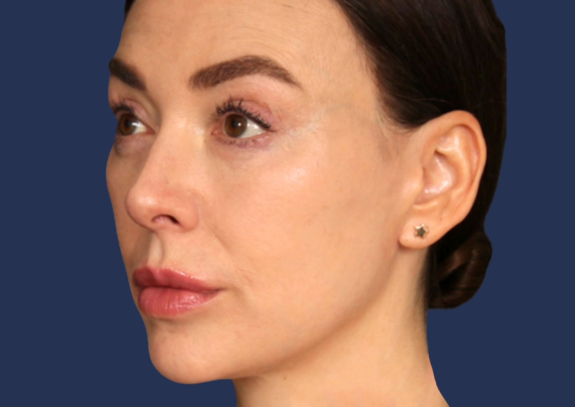 Under-eyes results after Lipoderma