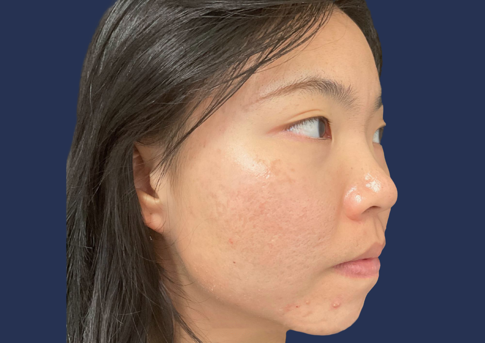 Midface results after Lipoderma
