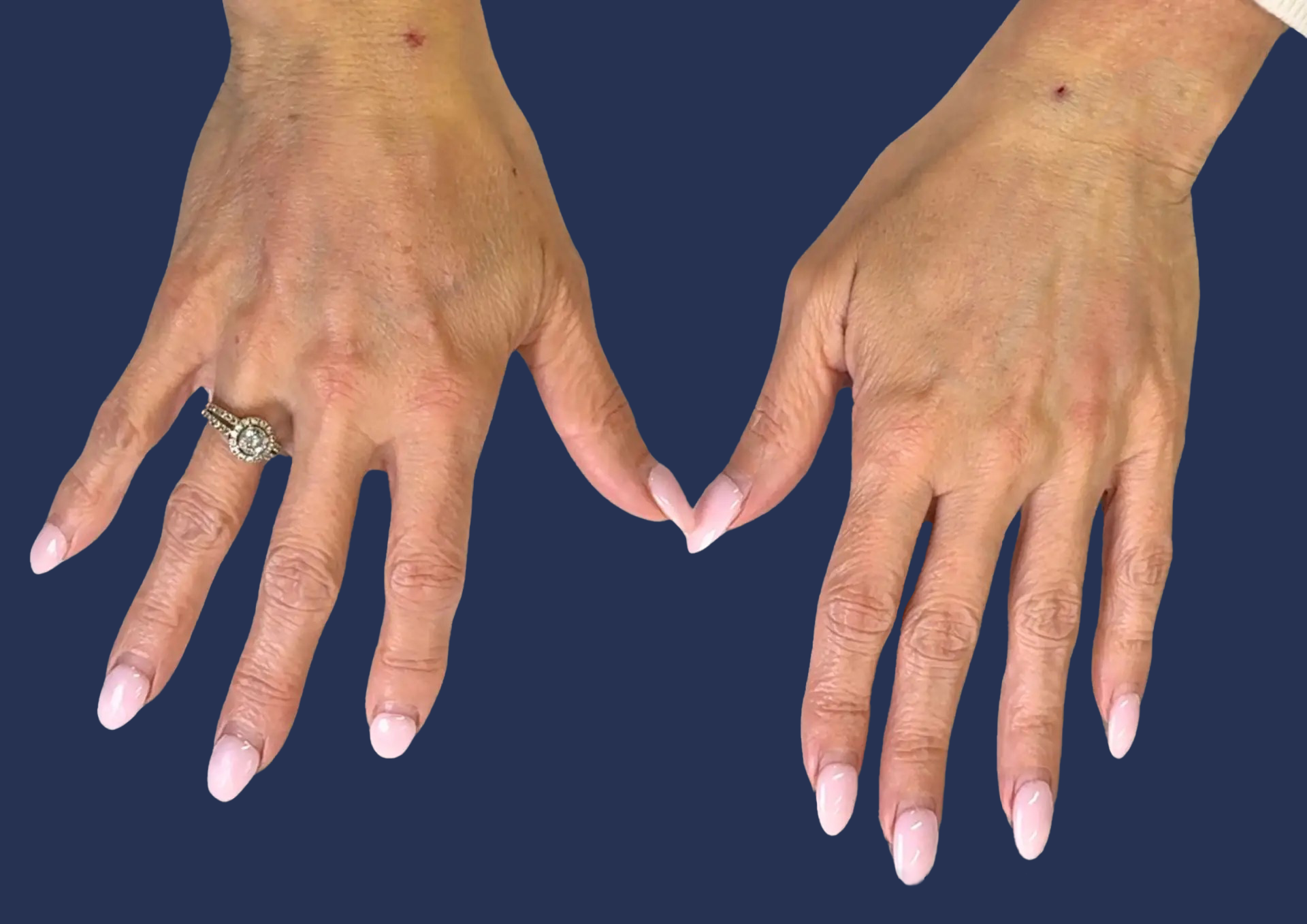 Hands results after Lipoderma